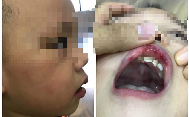 Tranh giành đồ với bạn, bé 3 tuổi bị cô giáo tát bầm mặt, tụ máu môi