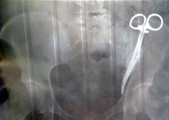 Bác sĩ để quên kéo y tế trong bụng người phụ nữ suốt 23 năm