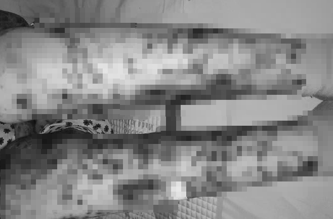 Bé gái Việt Nam đầu tiên mắc bệnh trên thế giới chỉ có 72 ca