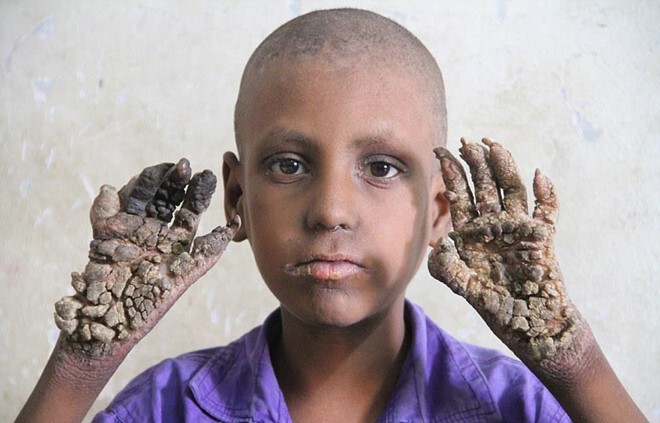 Cuộc sống bế tắc của những người bị 'mọc rễ cây'