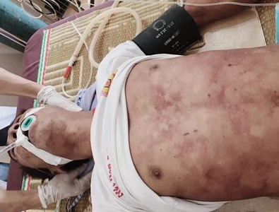 Thịt lợn chết liên hoan, một người đàn ông nhiễm liên cầu khuẩn thiệt mạng