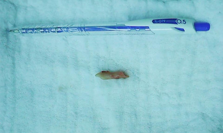 Quái lạ, ăn cháo vịt lại bị hóc xương lợn