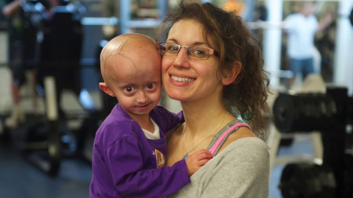 Bí ẩn căn bệnh khiến cô bé 3 tuổi như bà lão 80