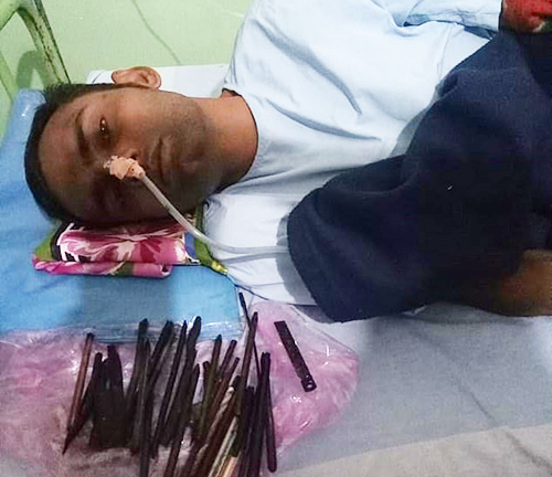 Chàng trai nuốt hàng chục dao, lưỡi lam và tuốc nơ vít vào bụng