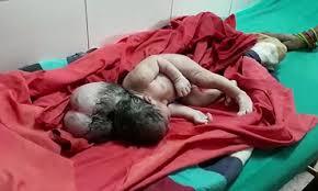 Bé sơ sinh Ấn Độ có 'ba đầu'