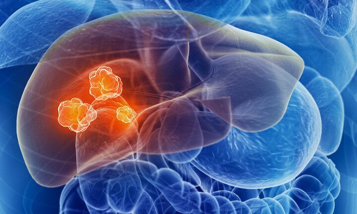 Ung thư gan cận kề nếu 4 dấu hiệu này xuất hiện trên mặt