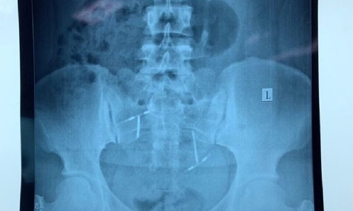 Vòng tránh thai ‘đi lạc’ trong bàng quang người phụ nữ ở Quảng Nam