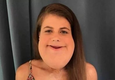 Cô gái sống lạc quan mặc kệ khối u lớn trên mặt