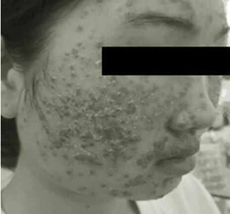 Dùng bột rửa mặt mua trên mạng, mặt thiếu nữ 22 tuổi chi chít mụn nước