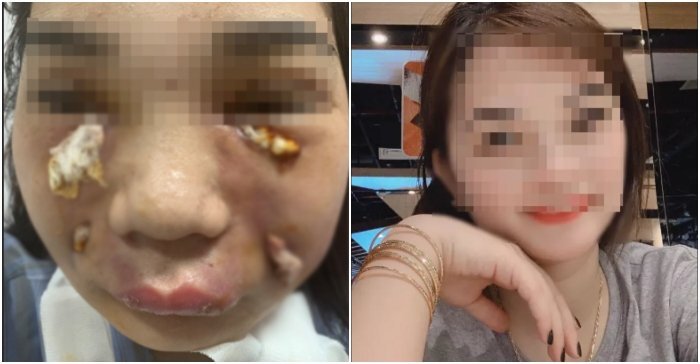 Clip: Cô gái ở Hà Nội hoại tử vùng mặt sau tiêm mỡ tự thân