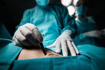 Phẫu thuật thẩm mỹ tân trang 'vòng 3', người phụ nữ bị hoại tử mông nặng