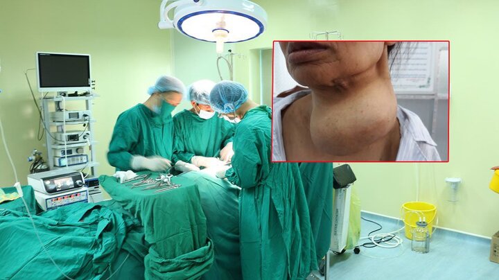Khối u bướu giáp khổng lồ trên cổ người phụ nữ vừa được phẫu thuật thành công