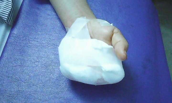 Đang xay thịt, người phụ nữ ở Quảng Nam bị 'nuốt' 4 ngón tay