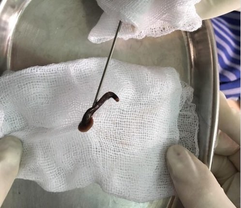 Con đỉa dài gần 8cm sống trong khí quản bé trai