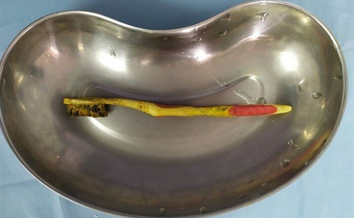 Hy hữu, người đàn ông nuốt cả bàn chải đánh răng vào bụng