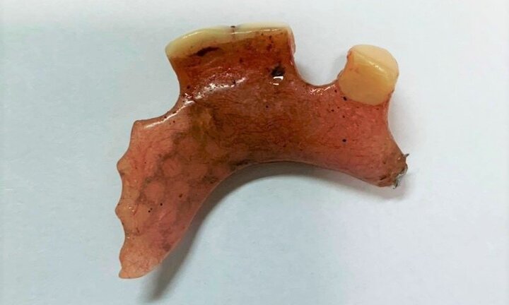 Cung răng dài 30mm án ngữ trong thực quản người phụ nữ ở Quảng Nam