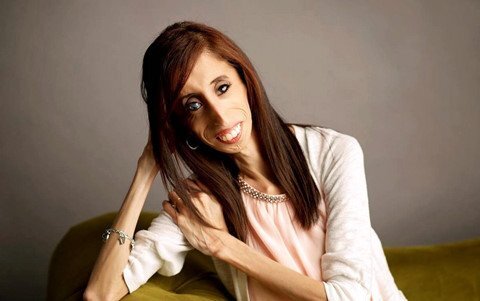 Video: Nghị lực phi thường của 'người phụ nữ xấu nhất thế giới'