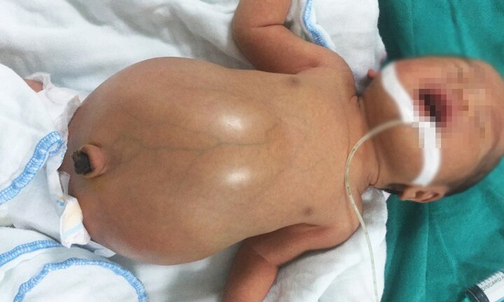 Cứu sống bé trai 2 ngày tuổi bị tắc ruột bẩm sinh