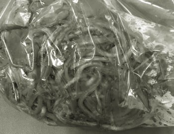 100 con giun ngoe nguẩy trong bụng bé 11 tuổi