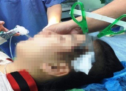 Cứu sống bé gái 10 tuổi bị kéo đâm vào đầu