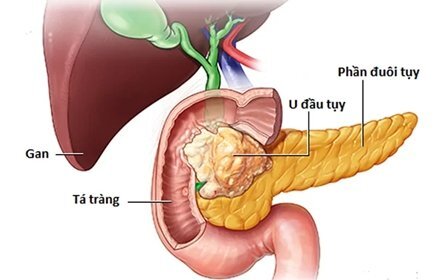 Những dấu hiệu sớm cảnh báo ung thư tuỵ bạn cần lưu ý