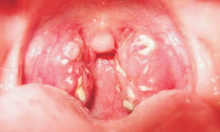 Điều trị cách ly bé trai 7 tuổi ở Quảng Ngãi bị bệnh bạch hầu