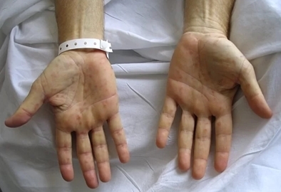 Con chào đời bị giang mai, mẹ mới biết mắc bệnh