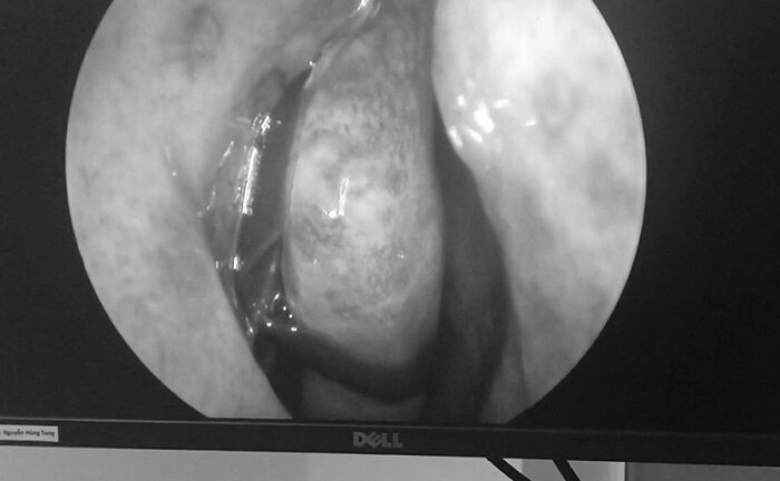 Hắt hơi, ngạt mũi, đi khám mới biết con vắt hút máu đang 'ngoe nguẩy' trong mũi