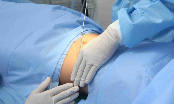 Hút mỡ bụng tại thẩm mỹ viện, người phụ nữ nhập viện cấp cứu