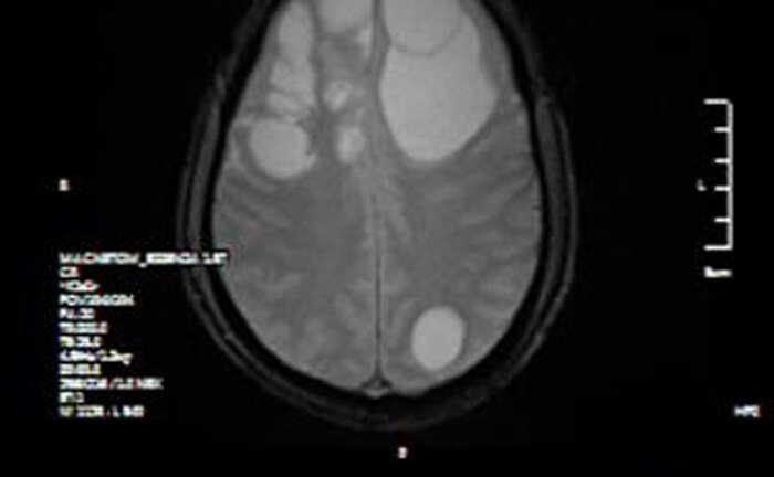 Ổ sán khổng lồ 'lúc nhúc' trong não người đàn ông ở Phú Thọ