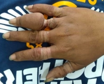 Đeo quá nhiều nhẫn, tay người đàn ông biến dạng, suýt hoại tử