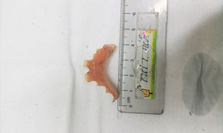 Người phụ nữ nuốt phải răng giả khi uống thuốc