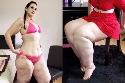 Hội chứng lạ khiến chân người phụ nữ chứa hơn 80 lít chất béo thừa