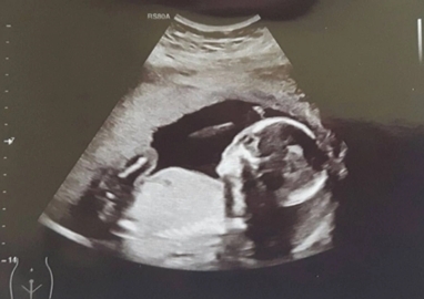 Người phụ nữ có hai tử cung vẫn sinh con bình thường