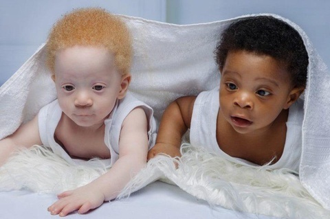 Video: Cặp sinh đôi một da đen, một da trắng hiếm gặp