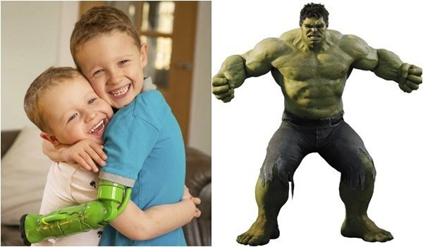 Bé trai đầu tiên ở Anh được lắp tay giả trên khuỷu với cảm hứng từ Người khổng lồ xanh