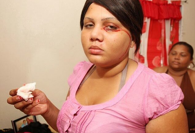 Vì sao ngày càng nhiều người mắc bệnh đổ mồ hôi máu cực kỳ nguy hiểm?