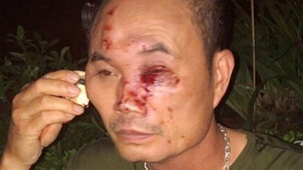 Bảo vệ khu chung cư Linh Đàm bị côn đồ đánh nhập viện