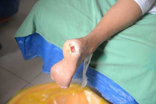 Không đùa đâu: Nguy cơ cụt chân, mù mắt vì... 'bệnh vào từ miệng'