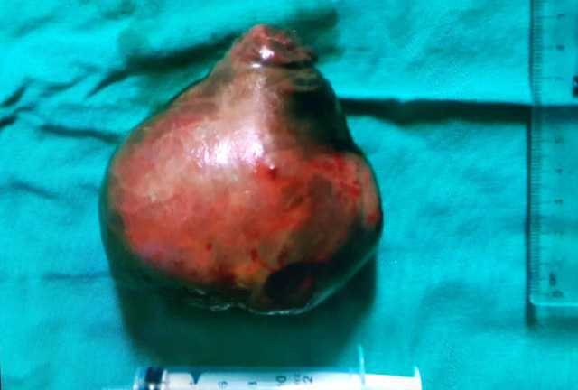 Bệnh nhân có khối u xơ tử cung khiến bụng to như mang thai