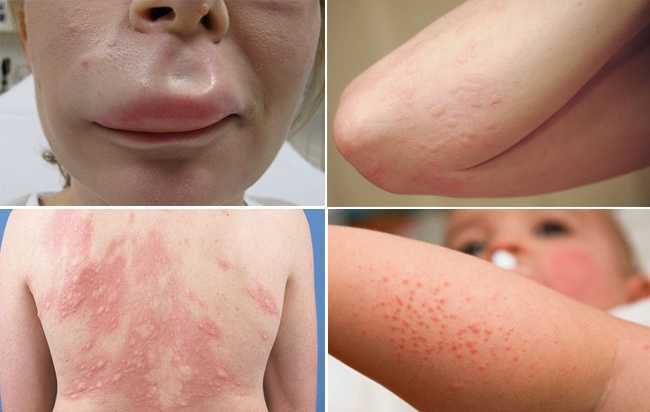 Tối nay gió mùa về, cẩn thận với chứng dị ứng thời tiết 'chết người'