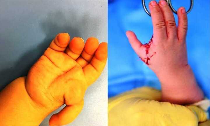 Bác sỹ kể chuyện 'hô biến' ngón trỏ thành ngón cái cho bé 1 tuổi bị dị tật bẩm sinh