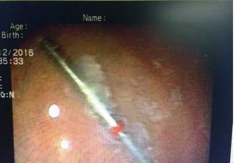 Phát hiện mũi khoan trong dạ dày bệnh nhân