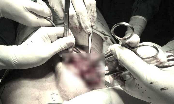 Bà mẹ trẻ xập xệ vì bơm silicon 'chui'