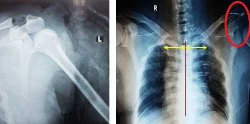 Đi bộ, bị đuôi xe tải đập gãy xương bả vai dạng hiếm gặp