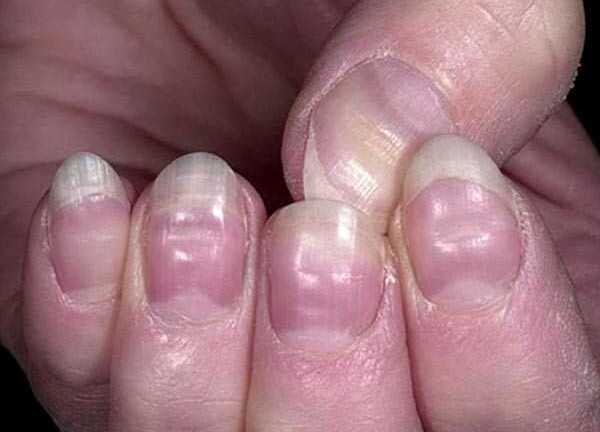 Nếu có những dấu hiệu bất thường trên móng tay, hãy đi khám ngay