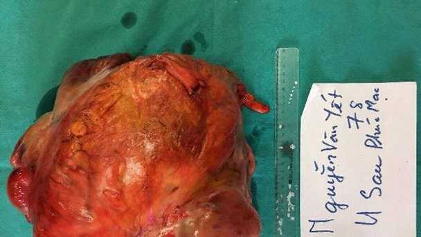 Cụ ông 84 tuổi mang khối u 10kg trong ổ bụng suốt hàng chục năm trời