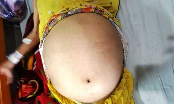 Người phụ nữ có khối u tử cung to như mang bầu