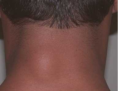 Vì sao nhiều người bỗng dưng mọc bướu mỡ?