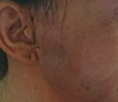 Thiếu phụ Sài Gòn nhiễm trùng máu vì bơm chất xóa nếp nhăn đón Tết